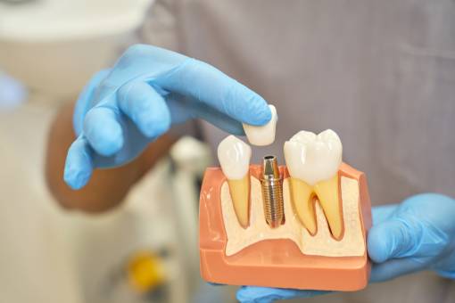 Implant Prosthetics